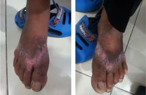 berbagai penyakit kulit, dermatitis